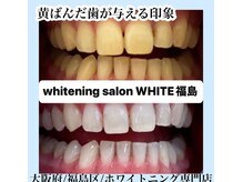 ホワイトニングサロン ホワイト(WHITE)/セルフホワイトニング/大阪/福島