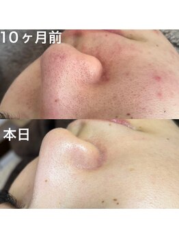 オードリー(Audrey)/10ヶ月の肌変化