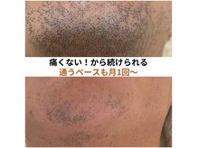 ビーボヌール(be-bonheur)の雰囲気（痛みが少ないヒゲ脱毛/他店からの乗り換えも多数しっかり抜ける）