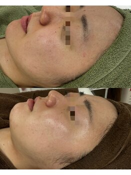 レイ(Lei)/ニキビ/毛穴/ハーブピーリング