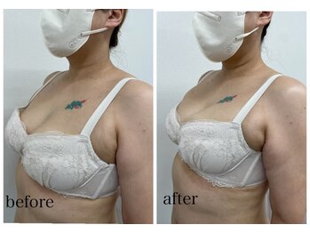 ルミエール(Lumiere)/【倉敷市】バストアップ施術事例