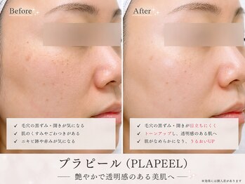 サロンドルル(salon de lulu.)の写真/韓国肌管理で、つるんと輝く素肌へ♪ララピール・プラピールで、肌悩みに合わせたピーリングケアを。