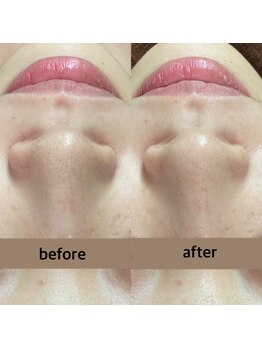 キノ(kino)/毛穴洗浄　ハイドロピーリング