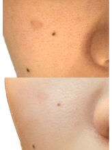 ベストベル(BestBelle)/低周波シミケアで透明美肌に！！