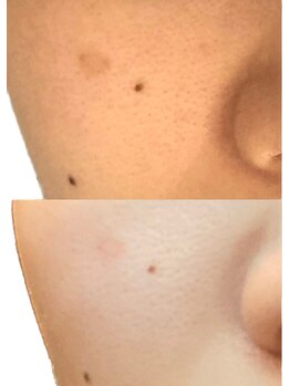 ベストベル(BestBelle)/低周波シミケアで透明美肌に！！