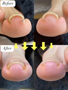 ニコワイズネイル(Nico Y's Nail)/【巻き爪緩和コース】