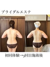 イム(I'm.)/ブライダルエステ　before/after