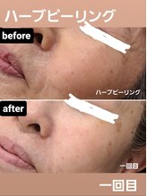 シス(SiS.)/ハーブピーリング