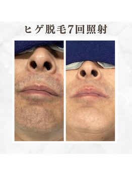 ボゴス(BOGOSS)/ヒゲ脱毛7回照射