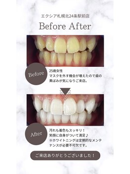 エクシアホワイト 平岸駅前店/ホワイトニング☆口コミのご紹介