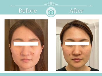 美人バスト 表参道店/【フェイシャル☆症例/表参道】