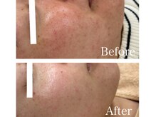 MMK/赤みもOFFハーブピーリング☆