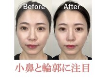 ラプリボーテ(Raplit BEAUTE)/隆鼻＋輪郭矯正40分1回