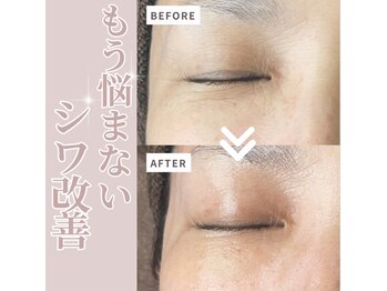 リラクゼーションサロン ラキ(laki)/ハイピールイントゥ/ピーリング