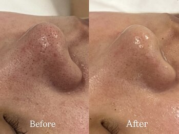 トム(Thom)/ヘッドスパ付★毛穴悩みにはコレ