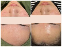 ナトラ 蔵前/20代後半肌質改善