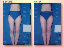 ジュリア オージェ 天王寺店/ビフォーアフター（美脚）
