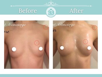 美人バスト 豊橋店/バストアップ症例【バストケア】