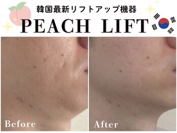 ヘティ バイ ソウル 中目黒(HETIY by Seoul)/ピーチリフト◇施術2回目