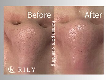 リリー(RILY)/【毛穴洗浄ビフォーアフター】