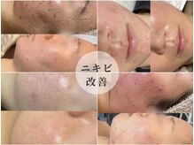 最短6ヶ月でシミ・ニキビ・毛穴改善。1度お悩みお聞かせ下さい◎