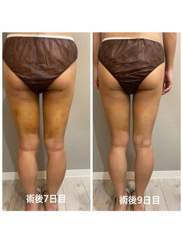 サロンシファ(salon sifa)/術後ケア