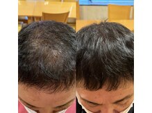 カナエル ビューティーサロン(Canael Beauty salon)/プロセルセラピーズ　8回