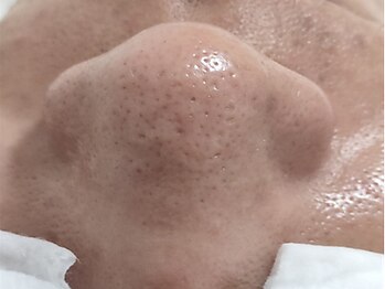 ホワイト アザブ(White Azabu)の写真/【SNSで話題】韓国式3D毛穴洗浄+スキンケア ¥16,000→¥8000！毛穴の汚れを除去し、キメの整ったお肌に♪