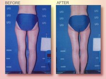 ジュリア オージェ 天王寺店/ビフォーアフター（美脚）