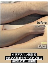 シンバ 倉敷店(SIMBA)/クリアスキン腕脱毛