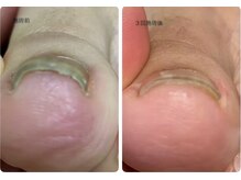 ロンディネ(Rondine)/巻爪ケア36