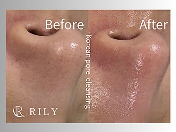 リリー(RILY)/【毛穴洗浄ビフォーアフター】