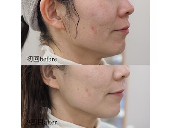 エクレクティック(ECLECTIC)/小顔/栃木エステ/宇都宮エステ