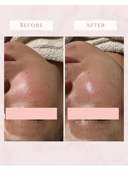 リチェルカ(Ricerca)/肌の赤みが落ち着きツルン肌に♪