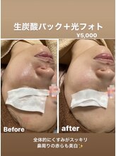 美顔秘密基地 新宮/生炭酸パック&光フォト