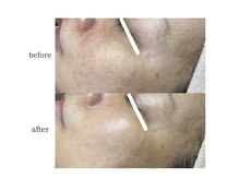 サロン ド ソワン(salon de soin)/ハーブピーリング