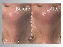リリー(RILY)/【毛穴洗浄ビフォーアフター】