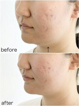 毛穴塾/話題の小顔マイクロリフト