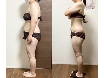 カトレア 下関店(KATOREA)/カトレアの痩身★BeforeAfter