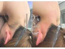 ベル(Belle)/【症例】うなじ骨格デザイン付き