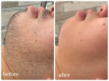 エリクサー 加須店(Elixir)/ヒゲ脱毛4回照射後before after!