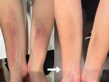 ヴィセラ(Vicella)/内出血が早く元通り