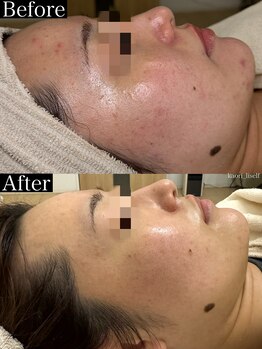 リセルフ(Liself)/コツコツ肌質改善!4ヶ月8回経過