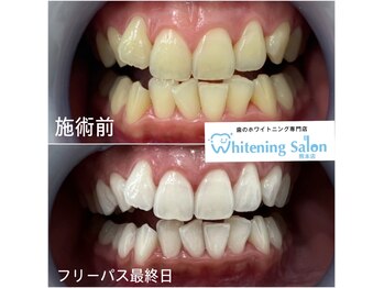 ホワイトニングサロン 熊本店