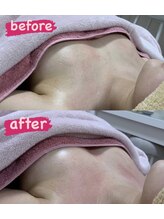 エムエム(mm)/NR機器/before・after