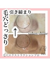 サロンシャイン(Salon Shine)/頑固な毛穴もスッキリ！