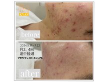 キャス(KYAS)の雰囲気（他店施術後→KYAS［茅ヶ崎/ハーブピーリング/ニキビケア］）