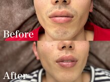 ボス 岡崎店(BOSS)/【顔脱毛/ヒゲ脱毛】両もみあげ