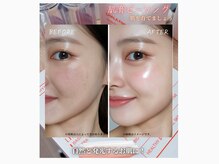 圧倒的人気メニュー【ララピール】地域最安\8800