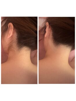 イヴ(Yves)/うなじbefore/after